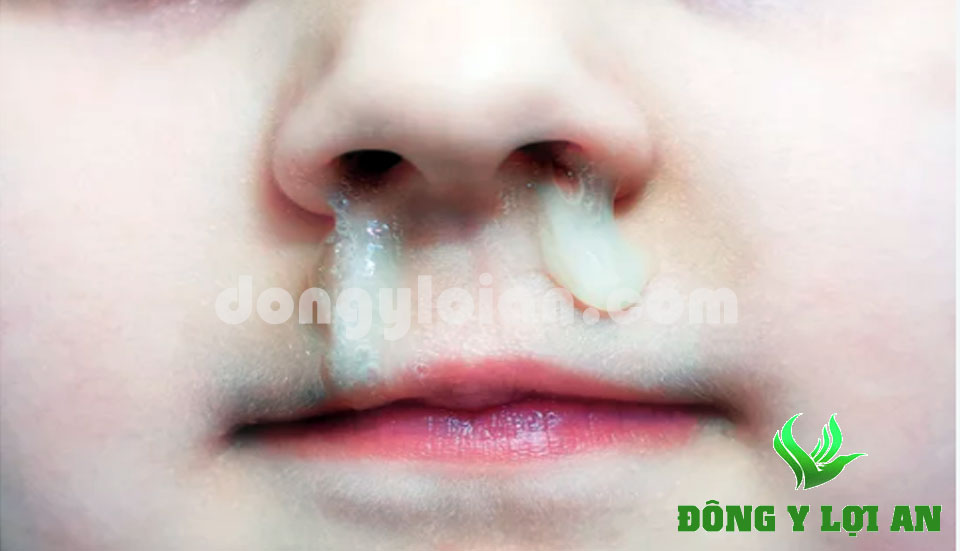 10 Loại thuốc trị sổ mũi nghẹt mũi cho bé