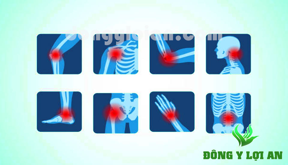 Cao Lợi An có tác dụng trị các dạng đau xương khớp