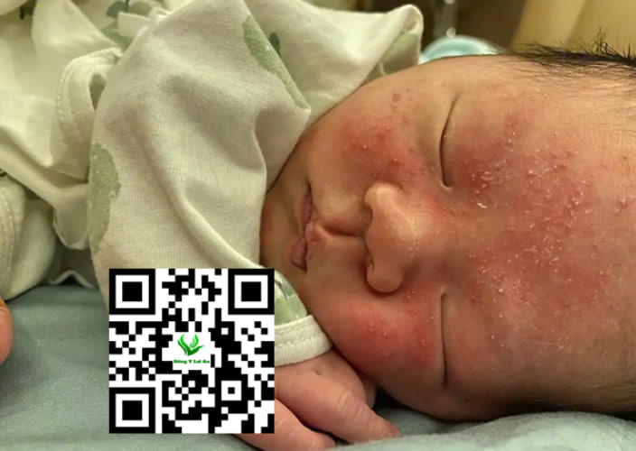 Bé bị chàm sữa bôi thuốc gì