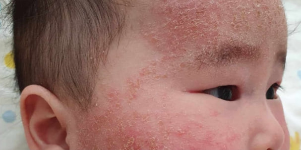 Bé bị chàm sữa mẹ nên kiêng ăn gì