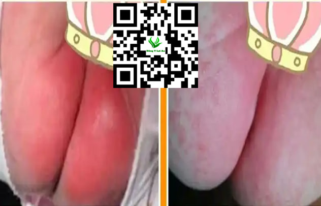 Bé bị hăm vào mùa hè