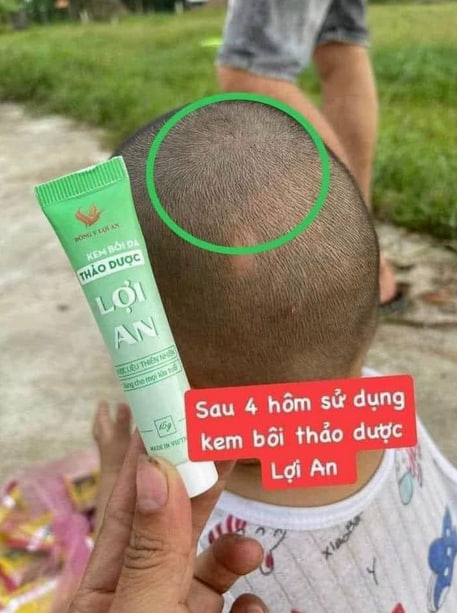 Bé bị nấm đầu đã khỏi sau khi sử dụng kem bôi da thảo dược Lợi An