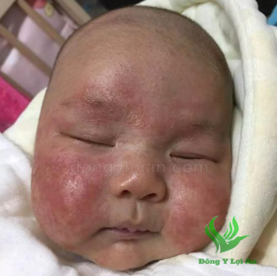 Bé giai đoạn đầu thử nghiệm phương pháp NMT