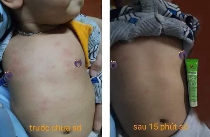 Bé nổi mẩn đỏ khắp người dịu đi sau 15 phút sử dụng kem Lợi An