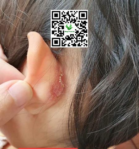 Bị Chàm sữa Sau Tai