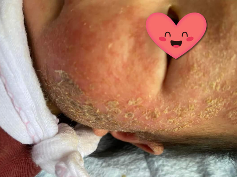 Các dấu hiệu ảnh hưởng đến thời gian khỏi chàm sữa