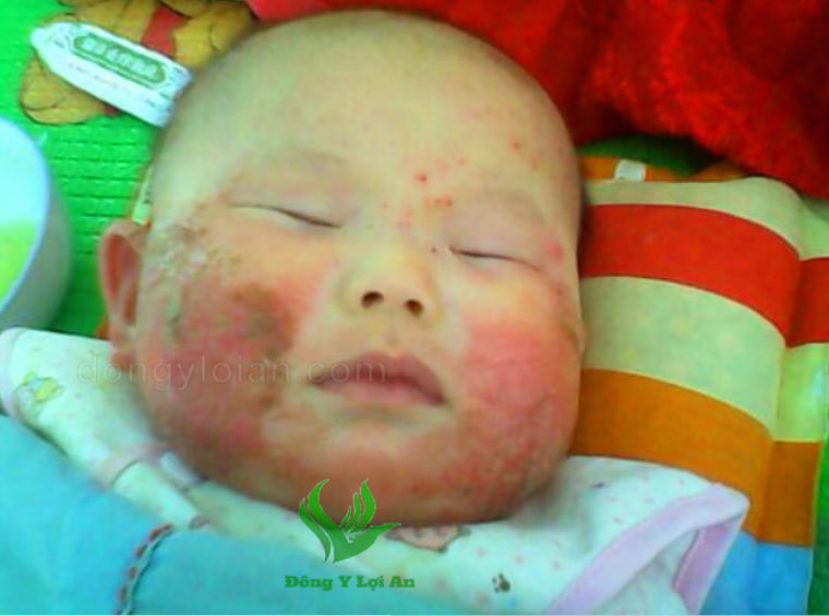 Các rủi ro khi áp dụng NMT cho bé