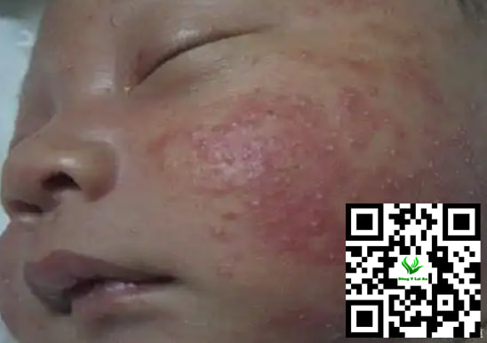 Cách Để Giúp Chàm Sữa Ở Trẻ Sơ Sinh Tự Hết