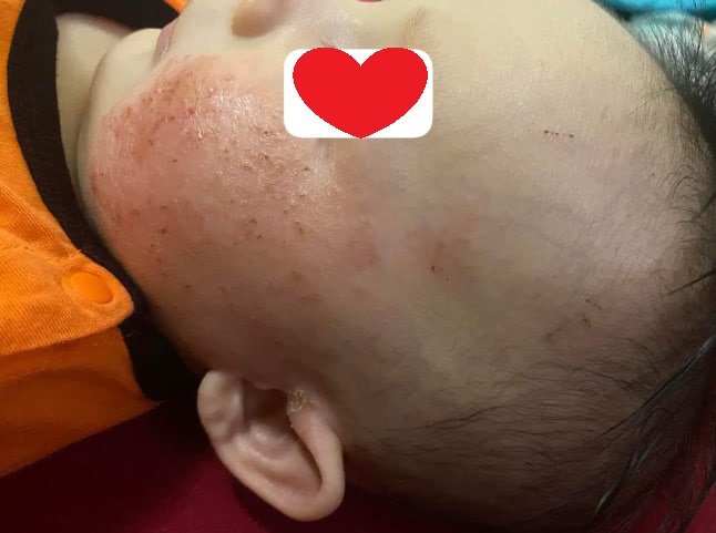 Cách giảm thiểu thời gian khỏi chàm sữa ở trẻ sơ sinh