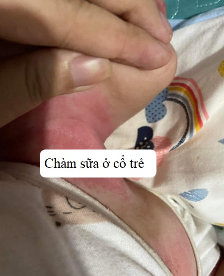 Chàm Sữa Mọc Ở Cổ