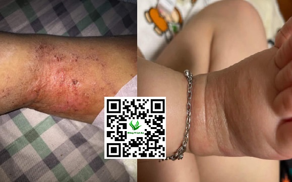 Chàm Sữa Ở Các Nếp Gấp Da của Bé