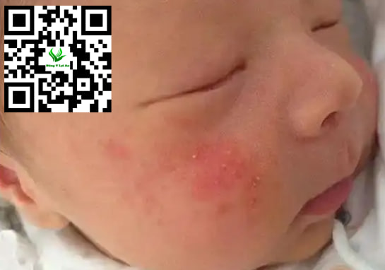 Chàm Sữa Ở Trẻ Sơ Sinh Có Tự Hết Không