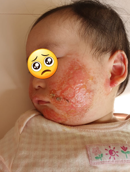 Chàm Sữa mọc ở mặt và cằm