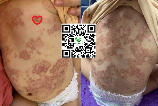 Chàm sữa mọc ở Lưng và bụng