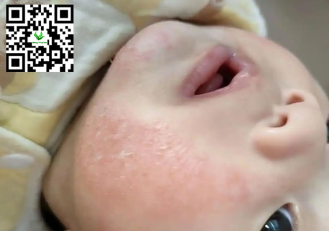 Chàm sữa ở trẻ sơ sinh