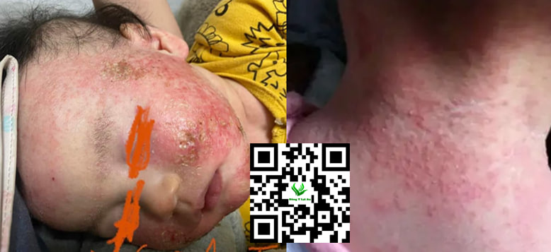 Chàm sữa và rôm sảy