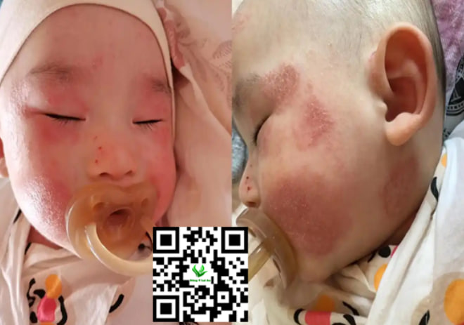 Điều Kiện Cần Thiết Để Chàm Sữa Tự Hết