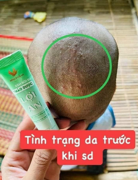 Hình ảnh Bé bị nấm đầu