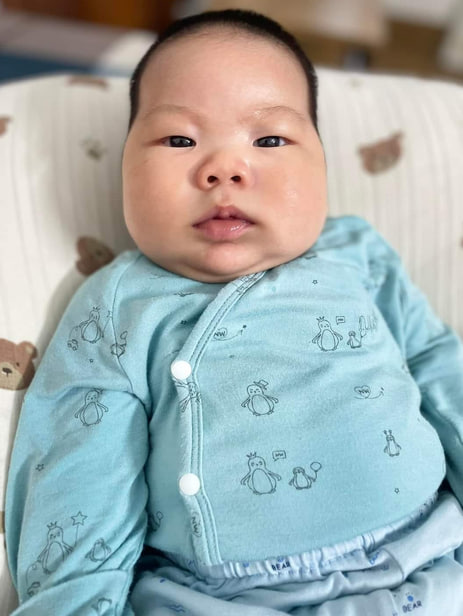 Hình ảnh bé bi chàm sữa nặng ở mặt đã khỏi sau khi sử dụng kem bôi Lợi An