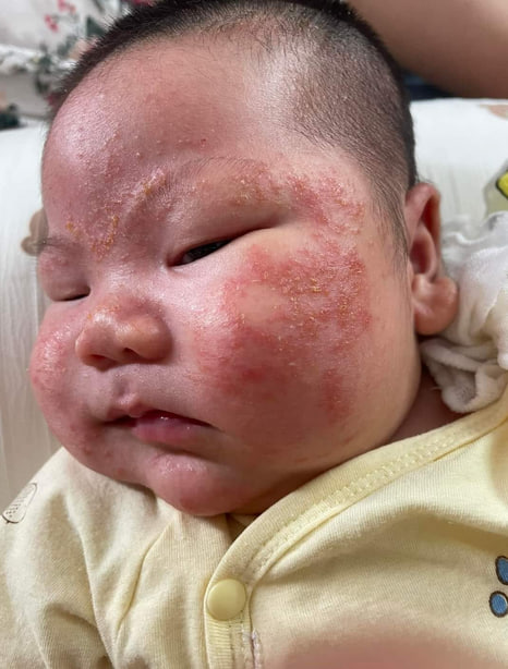 Hình ảnh bé bi chàm sữa nặng