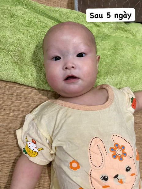 Hình ảnh bé bị chàm sữa ở mặt và viêm da tiết bã trên đầu đã khỏi