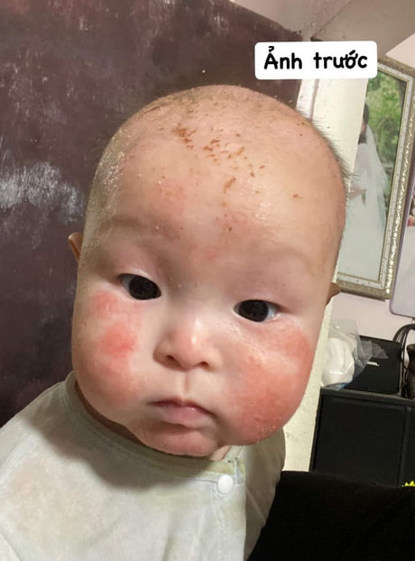 Hình ảnh bé bị chàm sữa và viêm da tiết bã trên đầu