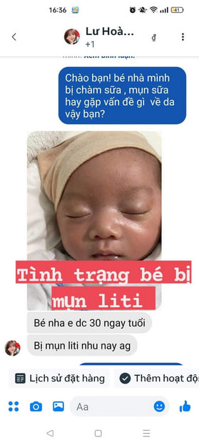 Hình ảnh bé bị mụn li ti trên mặt