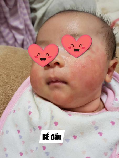 Hình ảnh chàm sữa bị dị ứng thực phẩm