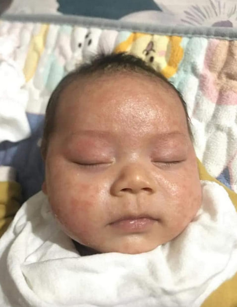 Hình ảnh chàm sữa ở trẻ sơ sinh