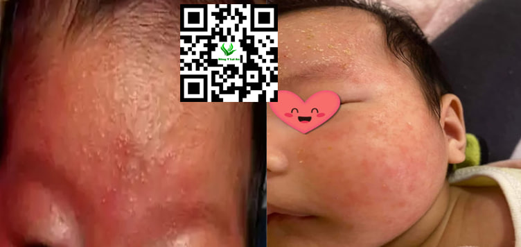 Hình ảnh mụn sữa và chàm sữa