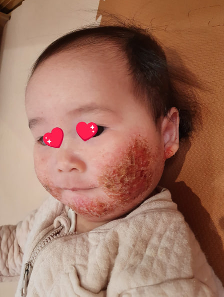 Nguyên nhân bé bị chàm sữa