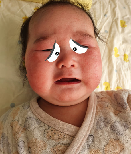 Nguyên nhân tại sao bé bị chàm sữa