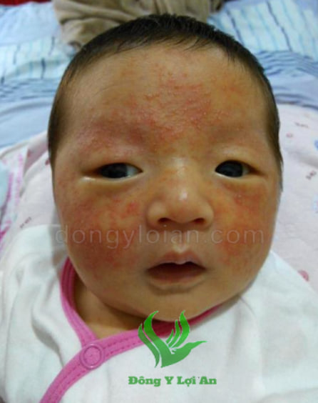 Phương pháp NMT - No Moisture Treatment