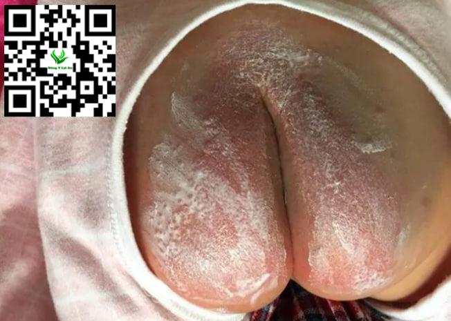 Sử Dụng Phấn Rôm Quá Mức