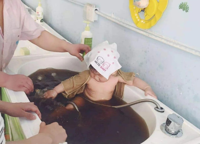 Tắm nước lá khế giảm ngứa do chàm sữa gây ra