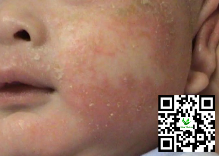 Thảo dược bôi chàm sữa cho bé