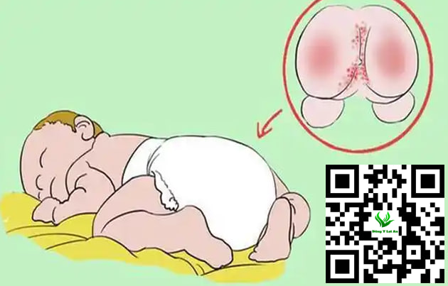 Thay tã và bôi kem chống hăm