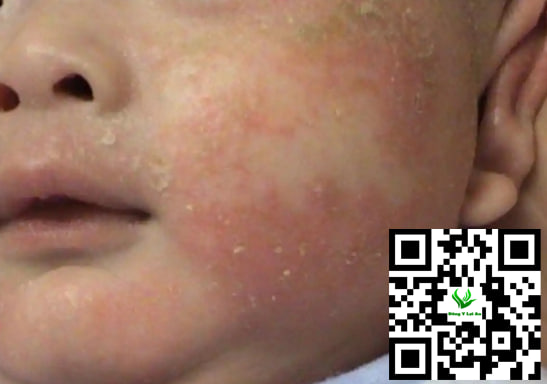 Thời Gian Tự Hết Chàm Sữa