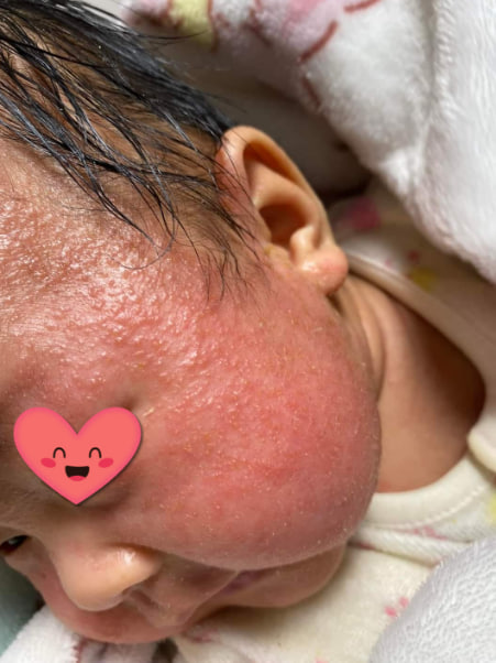 Thời gian khỏi bệnh chàm sữa ở trẻ em