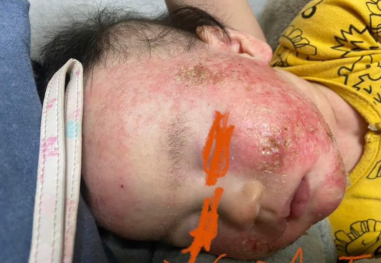 Thời gian khỏi bệnh phụ thuộc vào các cách điều trị