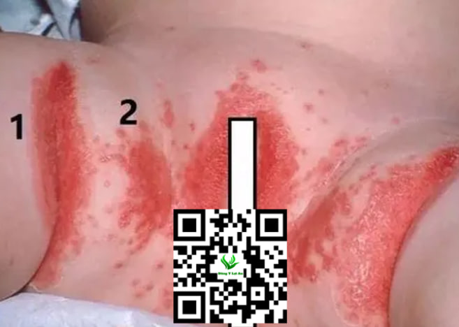 Vệ sinh vùng kín bé trai và bé gái bị hăm