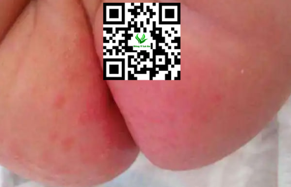 Bé dễ bị hăm da khi bí hơi trong mùa hè