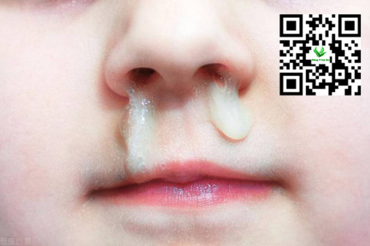 Bé bị chảy nước mắt, hắt hơi và sổ mũi liên tục