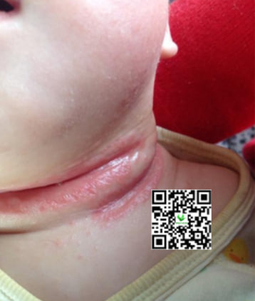 Bé bị hăm cổ mọc mụn nặng chảy máu