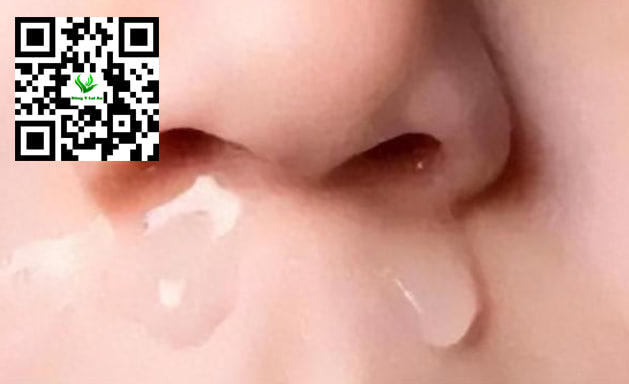 Bé sơ sinh bị sổ mũi, thở khò khè