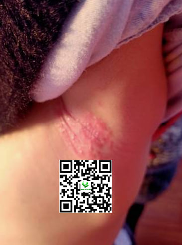 Biện pháp phòng ngừahăm nách cho bé hiệu quả