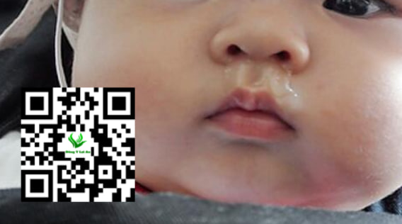 Các tác nhân gây sổ mũi ở trẻ 1 tháng tuổi