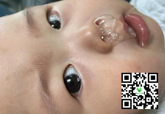 Các triệu chứng bé sổ mũi ho kéo dài