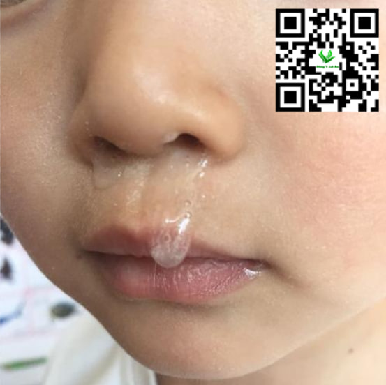 Cách Chữa Hắt Hơi Sổ Mũi Cho Bé Không Cần Thuốc