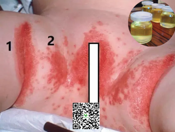 Cách Trị Hăm Bằng Dầu Dừa Cho Bé